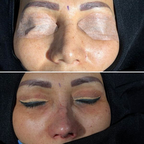 Nose Job