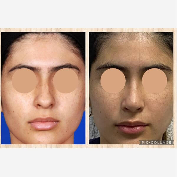 Nose Job