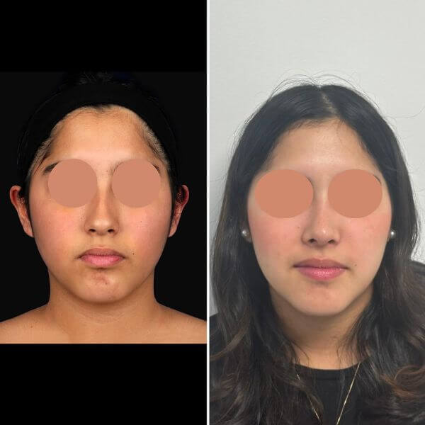 Nose Job