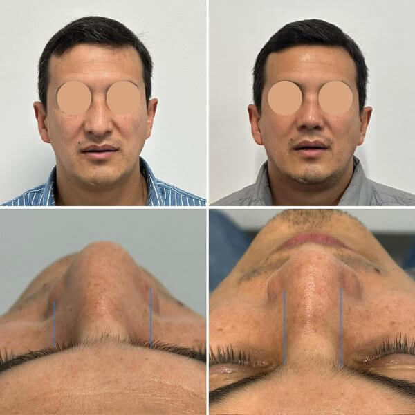 Masculine Nose Surgery