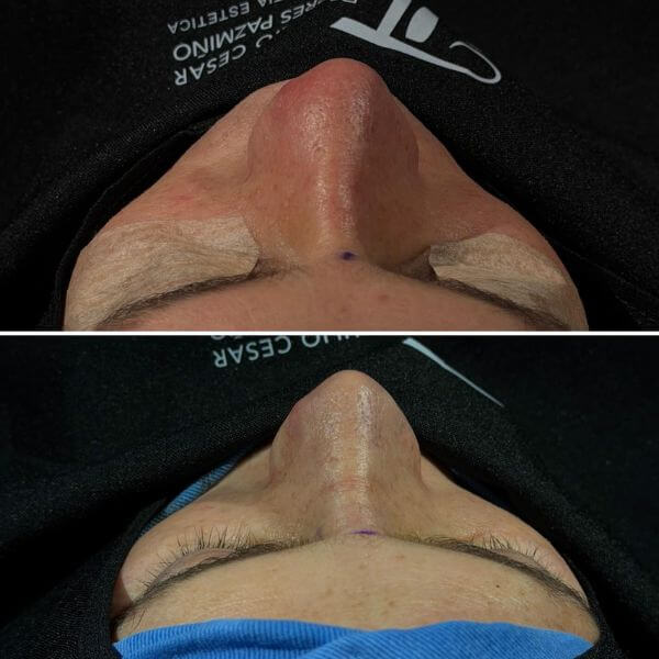 Nose Job
