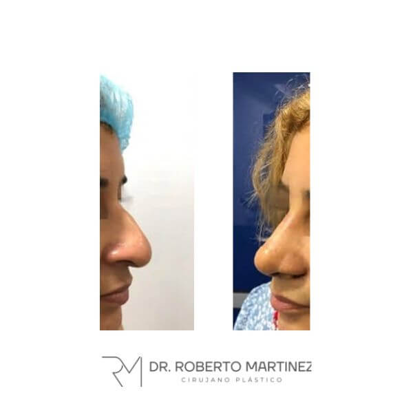 Nose Job