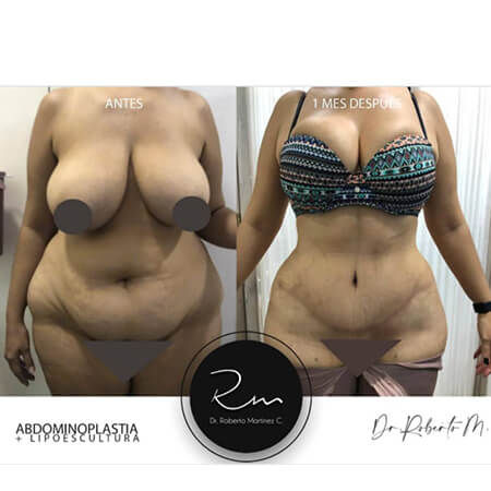 Tummy Tuck