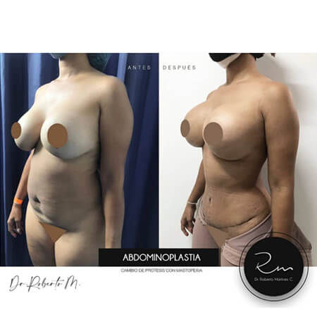 Tummy Tuck