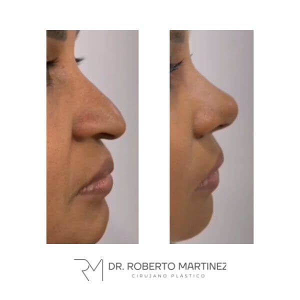 Nose Job