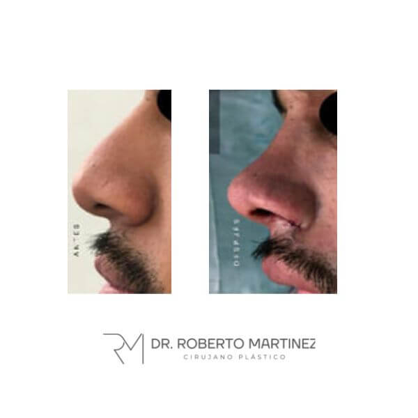 Masculine Nose Surgery