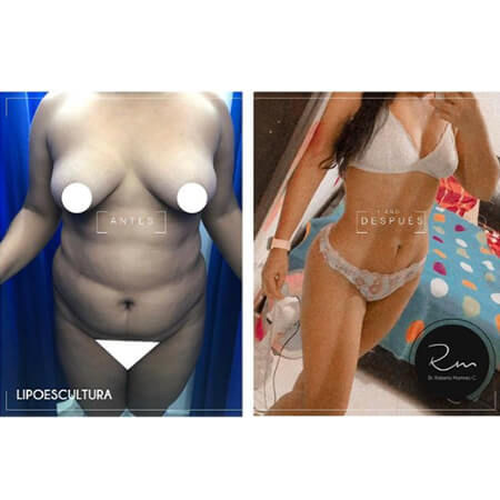 Liposculpture