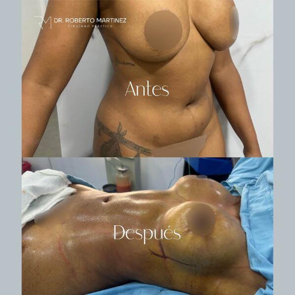 Tummy Tuck