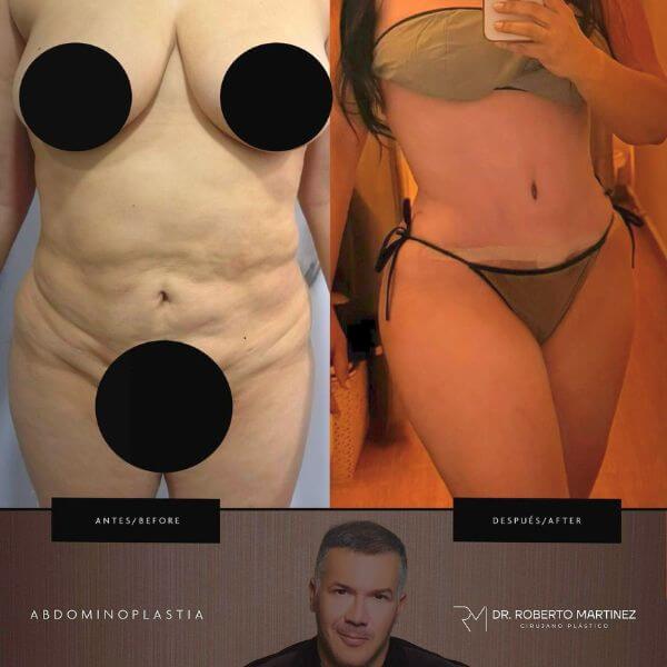 Tummy Tuck