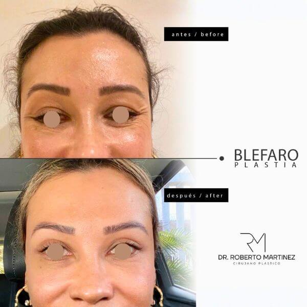 Eyelid Surgery