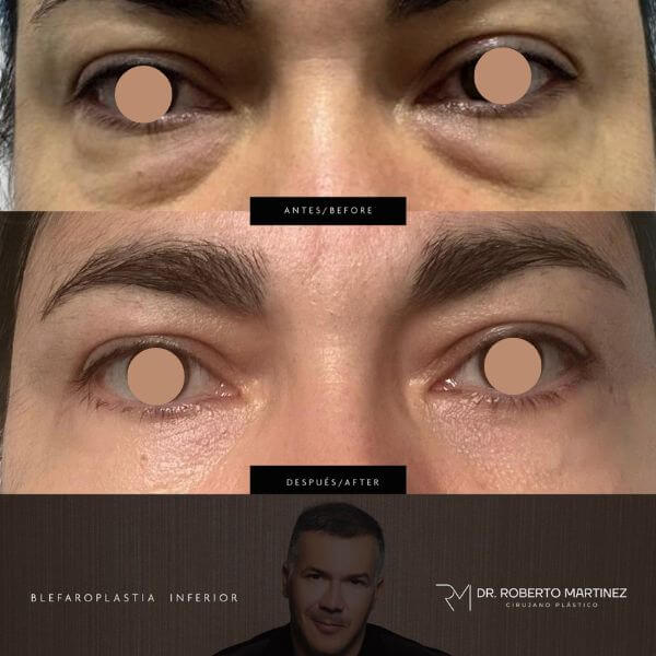 Eyelid Surgery