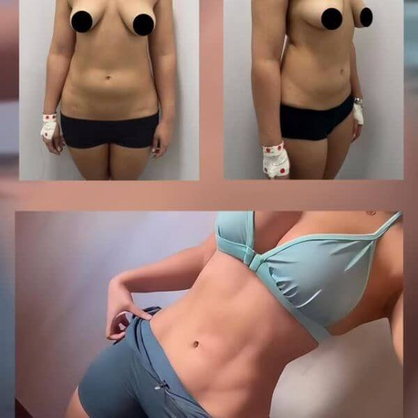Liposculpture