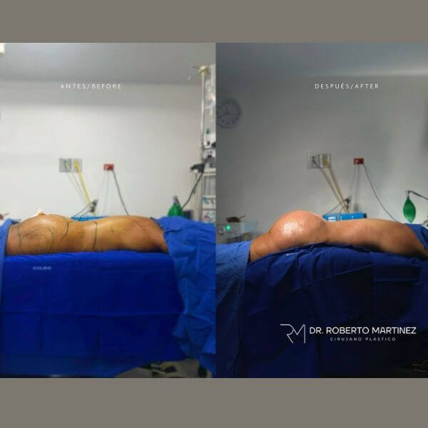 Brazilian Butt Lift BBL