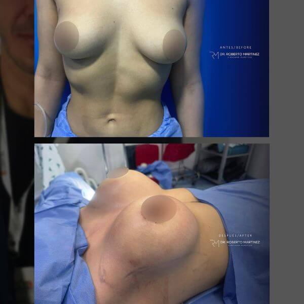 Breast Implant Surgery