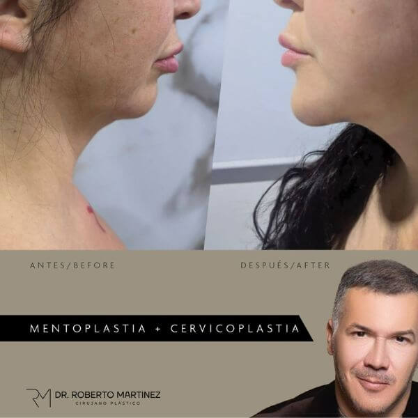 Chin Surgery