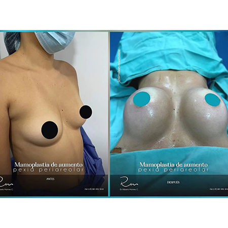 Breast Implant Surgery
