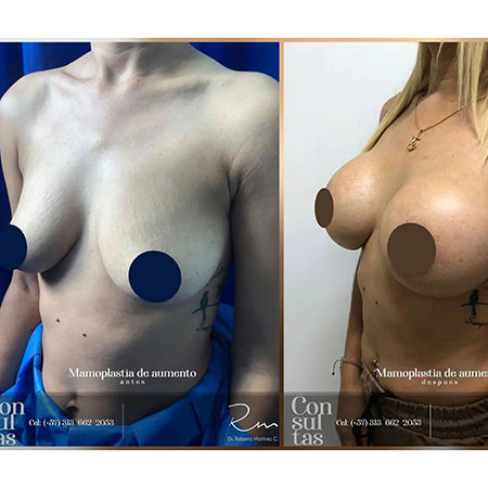 Breast Implant Surgery