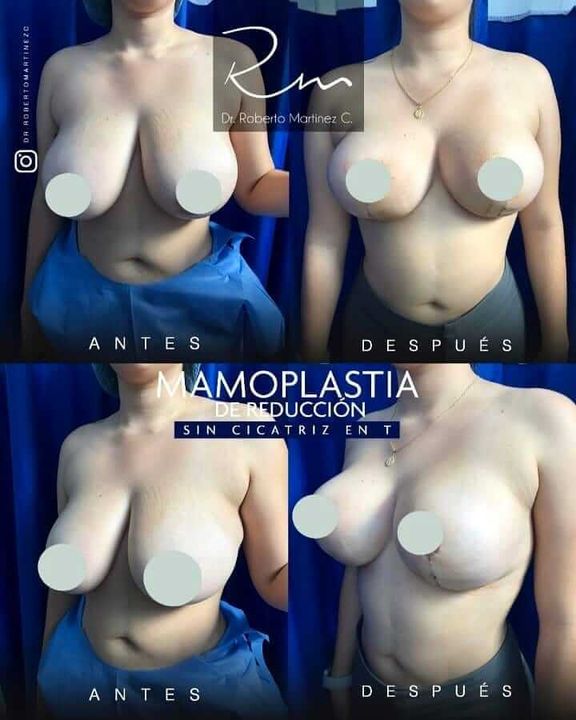 Breast Reduction