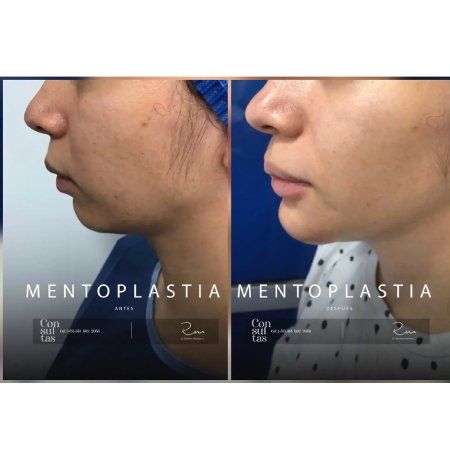 Chin Surgery