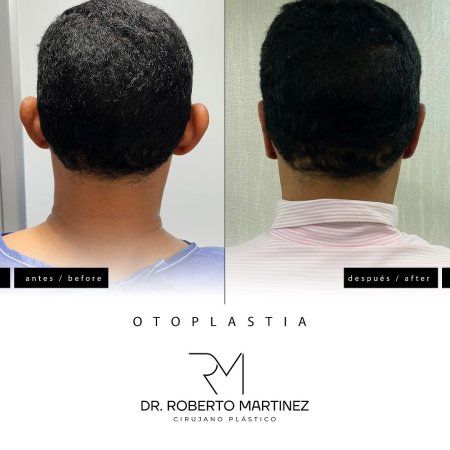 Otoplasty