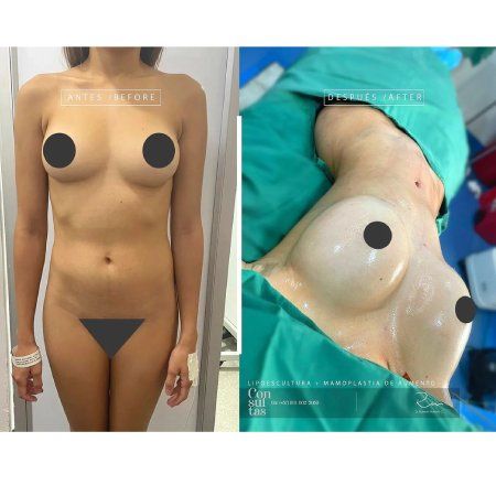 Breast Implant Surgery