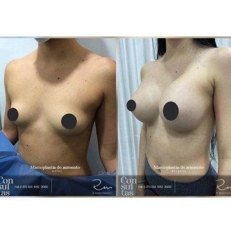 Breast Implant Surgery