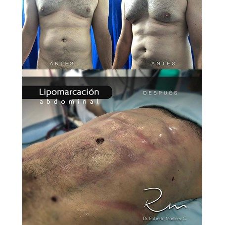 Men Abdominal Etching