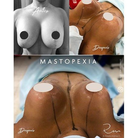 Breast Lift