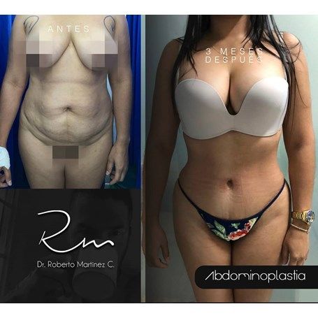 Tummy Tuck
