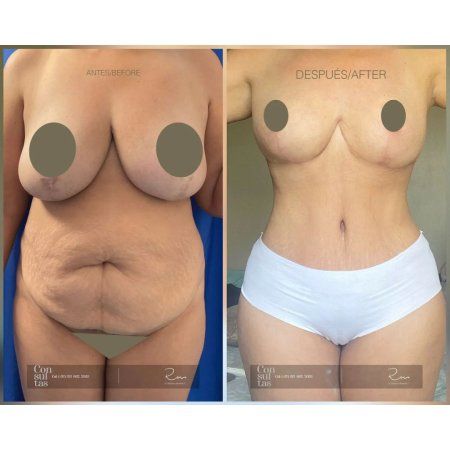 Liposculpture