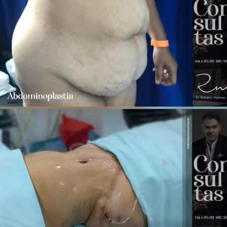 Tummy Tuck