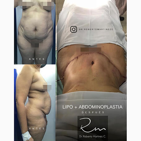 Tummy Tuck