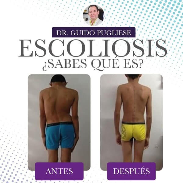 Colunm surgery