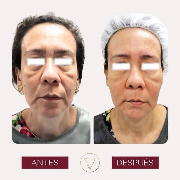 Facial rejuvenation