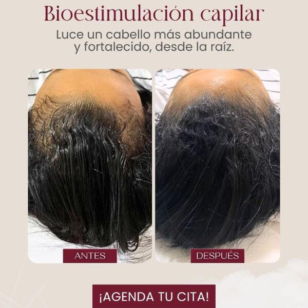 Alopecia