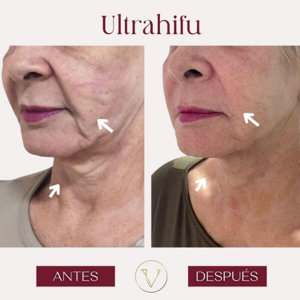 Ultrahifu