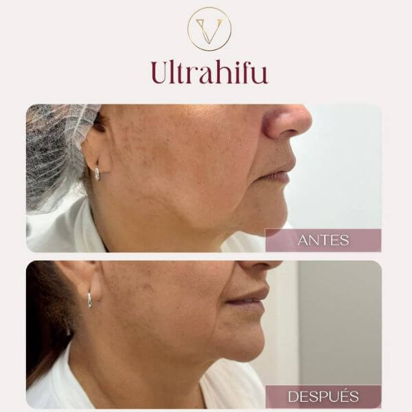 Non-surgical double chin correction