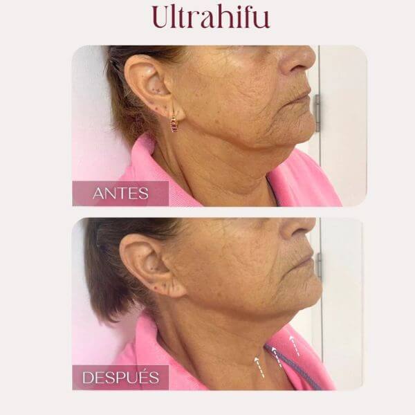 Neck rejuvenation