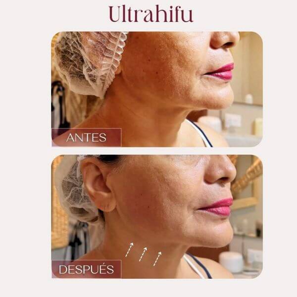 Facial rejuvenation