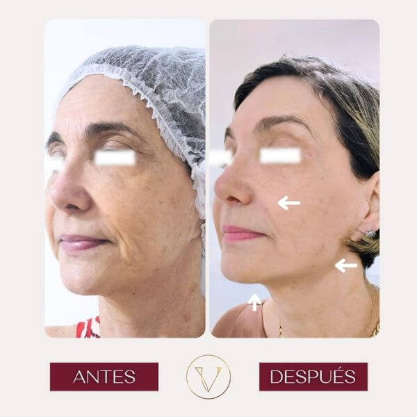 Facial rejuvenation