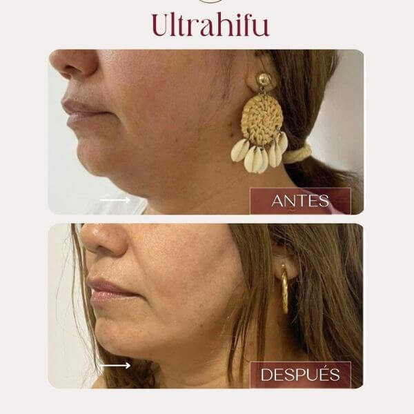 Non-surgical double chin correction