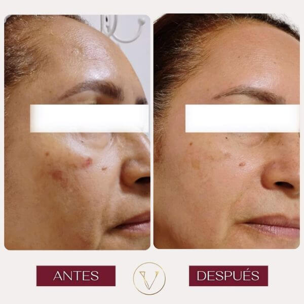 Dark spots