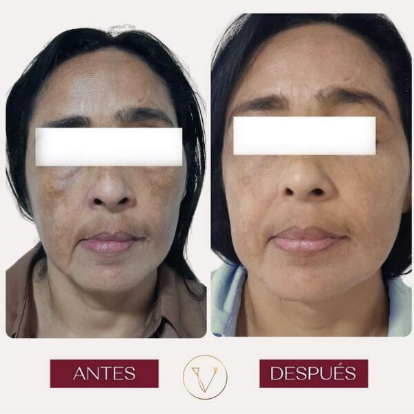 Dark spots