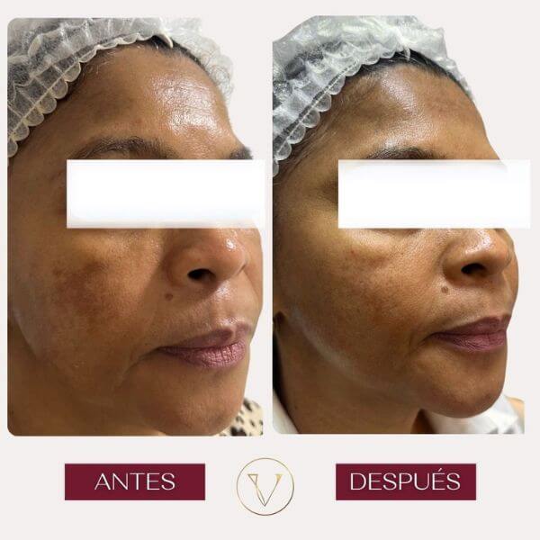 Dark spots