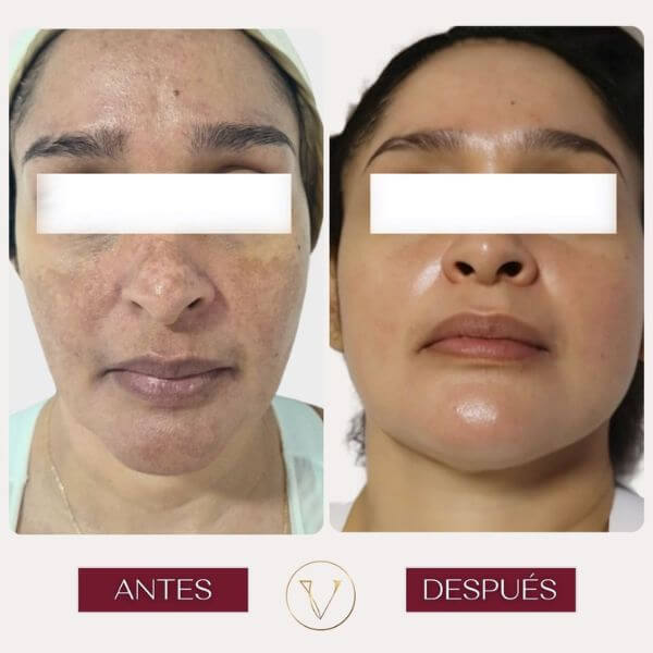 Dark spots
