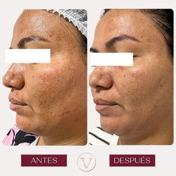 Dark spots