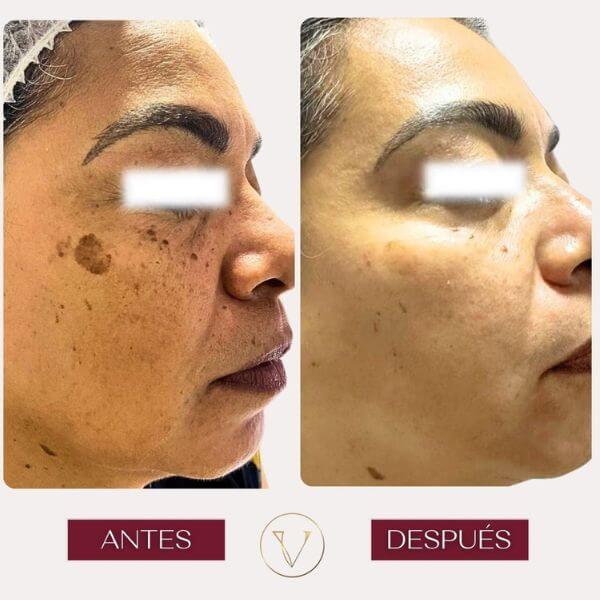 Dark spots