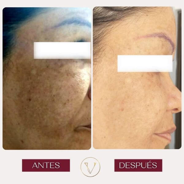 Dark spots