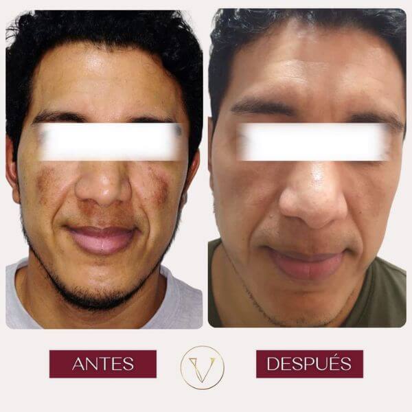 Dark spots