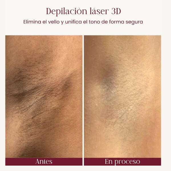 Laser hair removal